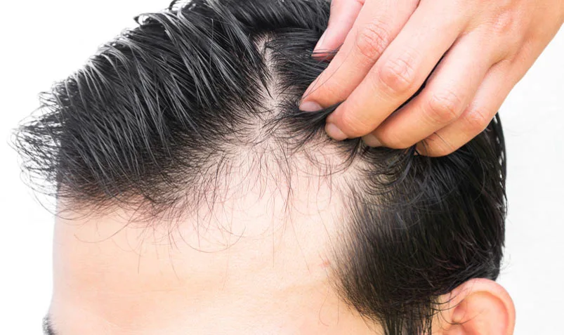 جلوگیری از ریزش مو با چند راهکار ساده
