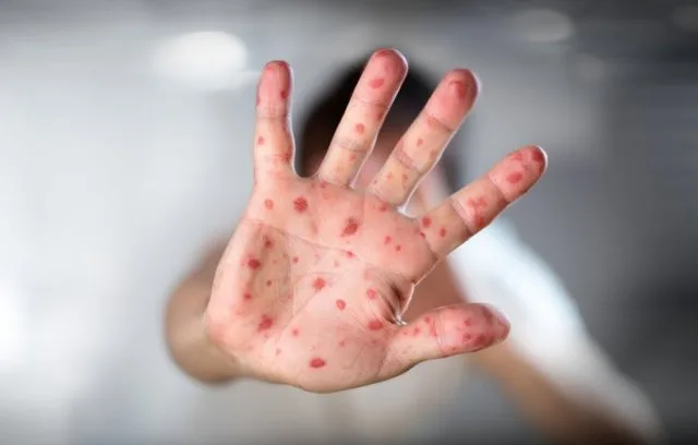 شیوع مجدد یک عفونت ویروسی مسری /ژاپن به حالت آماده باش درآمد
